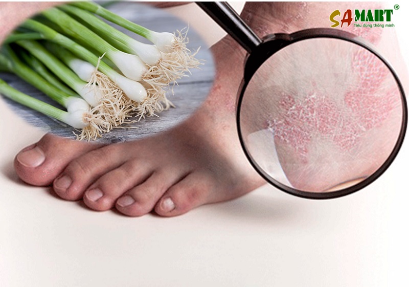 chua-dut-diem-benh-vay-nen-a-sung